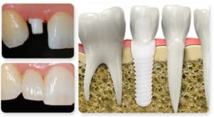 ¿Cuánto tiempo se tarda en obtener un implante dental