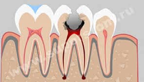 implante de endodoncia vs.