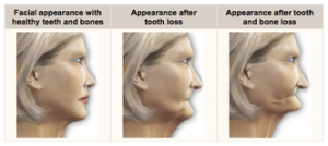 implantes dentales tiempo de curación