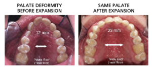 apnea obstructiva del sueño del dentista