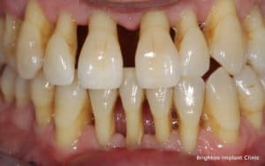 ¿Qué-causa-enfermedad periodontal?