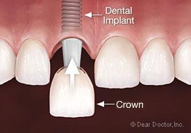 tiempo curativo dental del implante