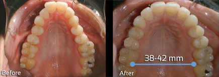 DNA appliance before and after pictures