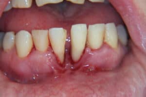 absceso dental de emergencia