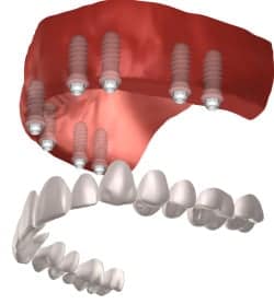 implantes dentales de boca completa