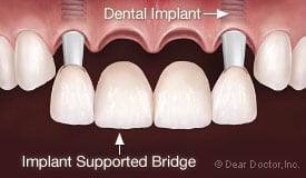 dientes del implante