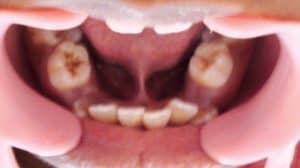 tongue tie crowded teeth