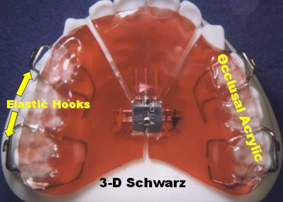 schwarz palate expander